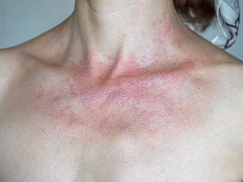 Alergia ao sol sintomas