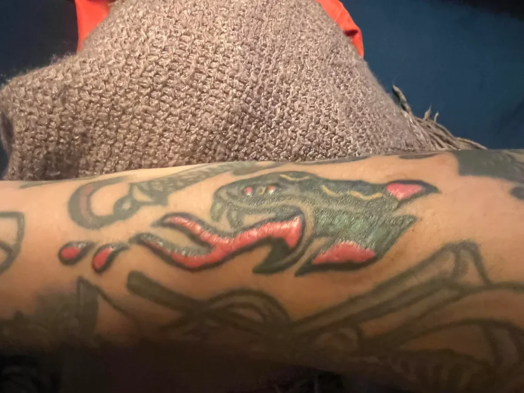 Alergia ao pigmento vermelho da tatuagem