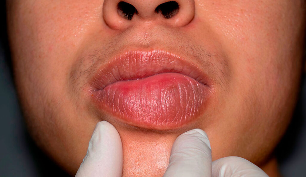 angioedema na boca