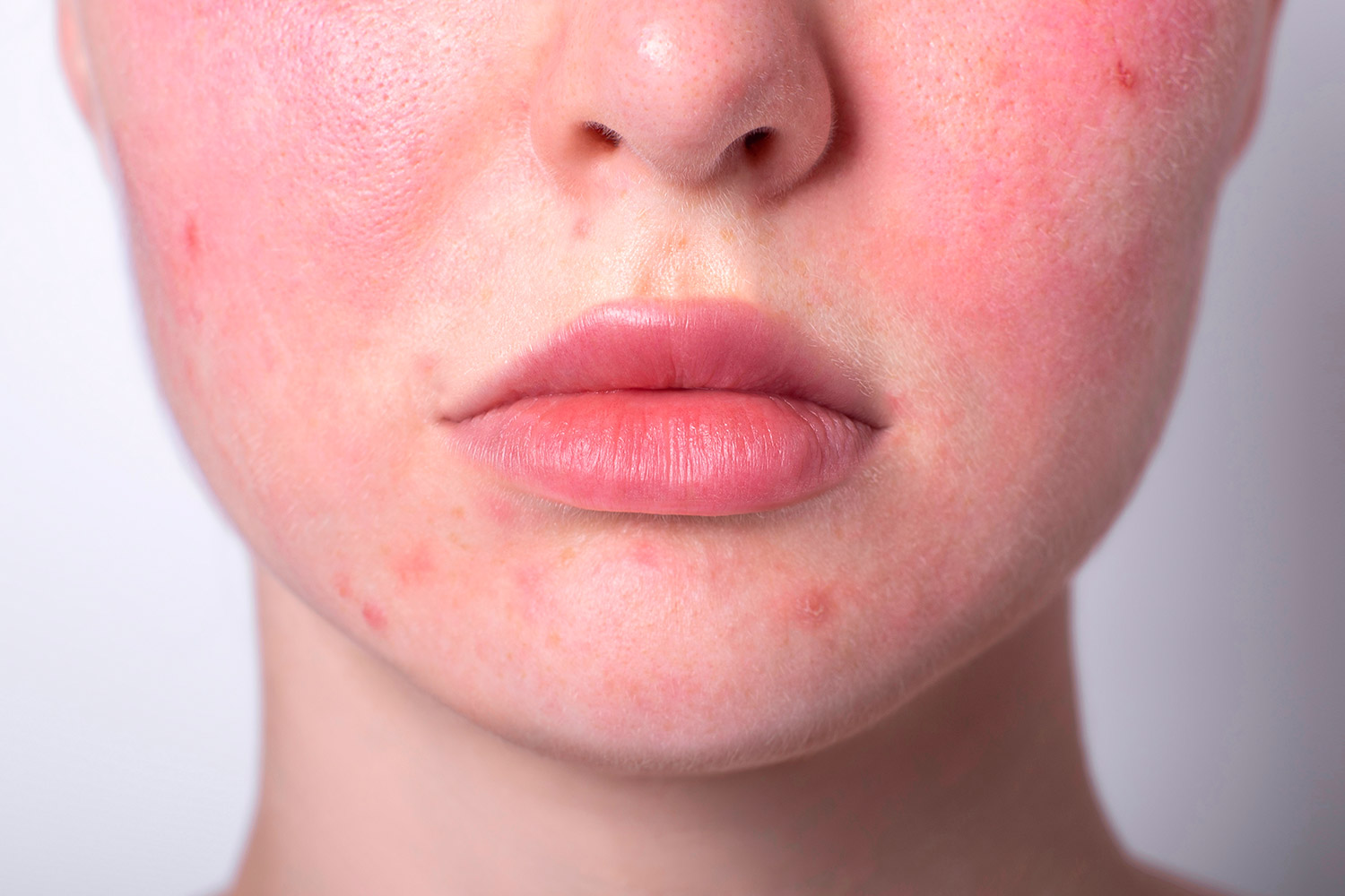 Alergia no rosto, lábios, pálpebras - O que pode ser? - Dermatologista ...