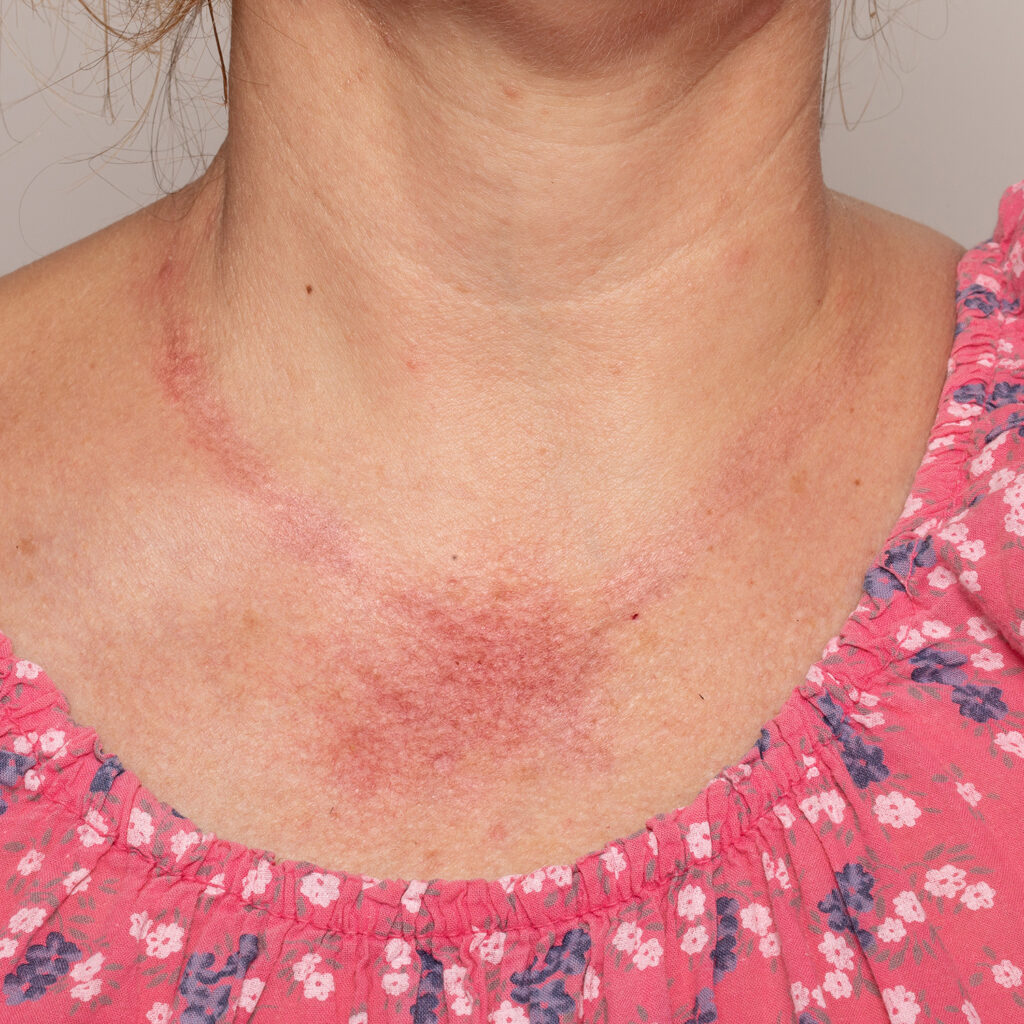 Alergia a níquel